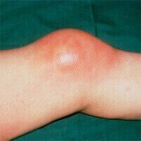 Nautubone za burzitis