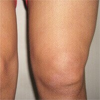 Nautubone za sinovitis